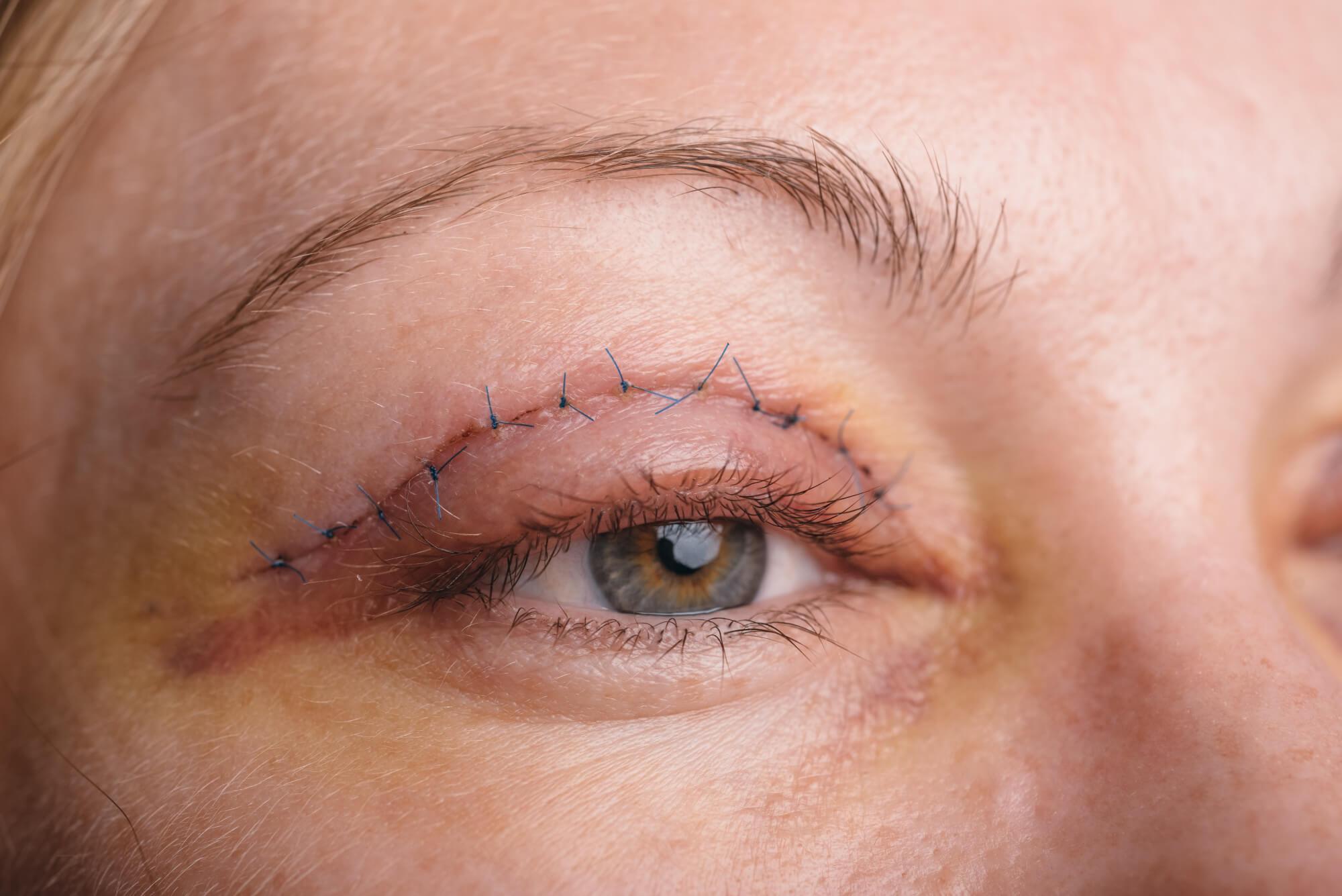 Your Guide to Eyelid Surgery Recovery - Popp Cosmetic Surgery PC